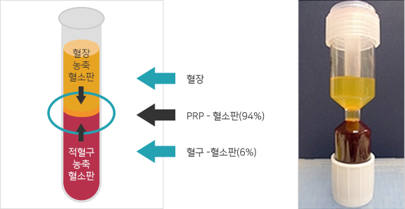 원심분리된 PRP