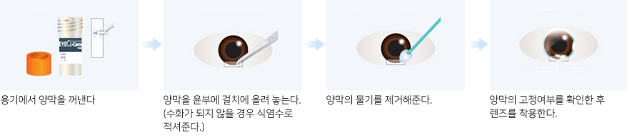 양막라섹 수술과정