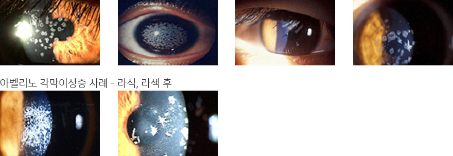 아벨리노 각막 이상증 (AVELLINO CORNEAL DYSTROPHY)