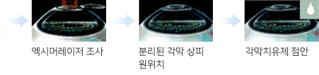 에피라식 수술과정