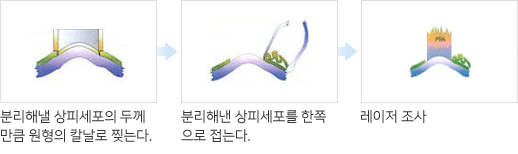 라섹수술과정