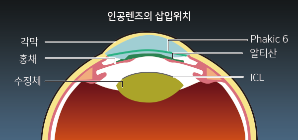 안내렌즈삽입위치