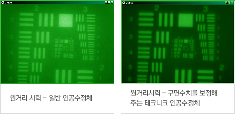 일반 단초점 인공수정체 시력