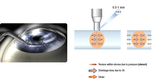 Ck 노안교정술 원리