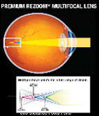 리줌 멀티포컬 인공수정체 초점 형성
