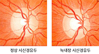 정상 시신경유두와 녹내장 시신경유두