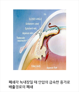 폐쇄각 녹내장일 때 안압의 급속한 증가로 배출경로의 폐쇄