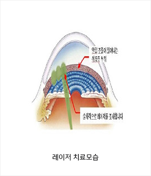 녹내장 레이저 치료모습