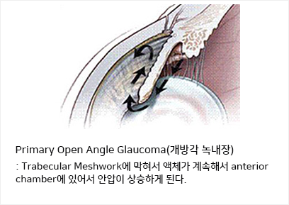 Primary Open-Angle Glaucoma