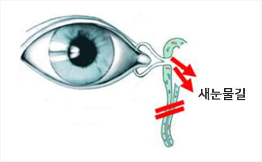 내시경눈물길 수술(코경유 눈물주머니 코안연결술)